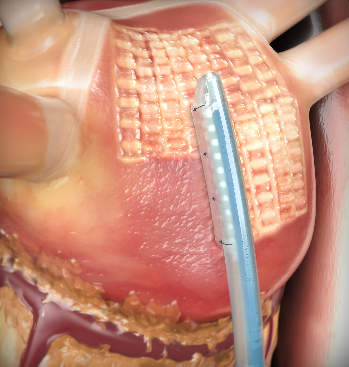 Minimally Invasive Ablation to Treat Atrial Fibrillation | AtriCure