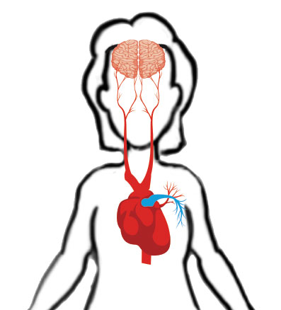 Atrial Fibrillation trigger area graphic
