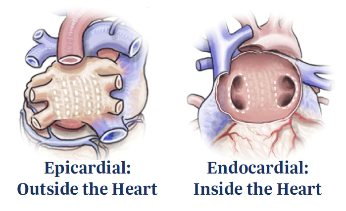 Heart Epicardial and Endocardial