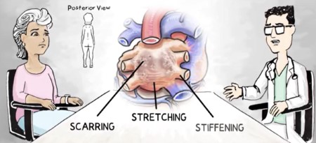 Scarring Stretching and Stiffening